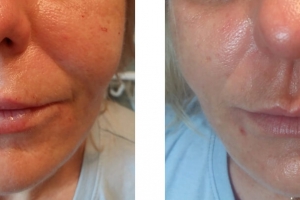 Volumetrische Gesichtsbehandlung (u.a. Gesichtsmodellierung, Behandlung der Nasolabialfurche, Falten